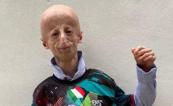 Умер самый долгоживущий человек с синдромом преждевременного старения — ему было 28 лет Умер самый долгоживущий человек с синдромом преждевременного старения — ему было 28 лет